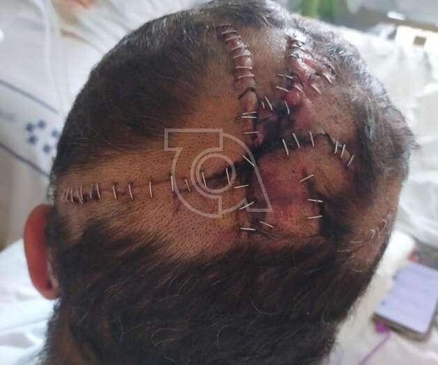 El vecino agredido muestra las heridas sufridas en la cabeza/TA.